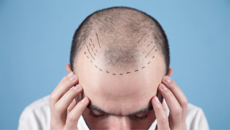 Man with a marked hairline before a hair transplant