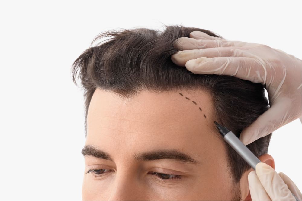A clinician marking a hairline before a hair transplant